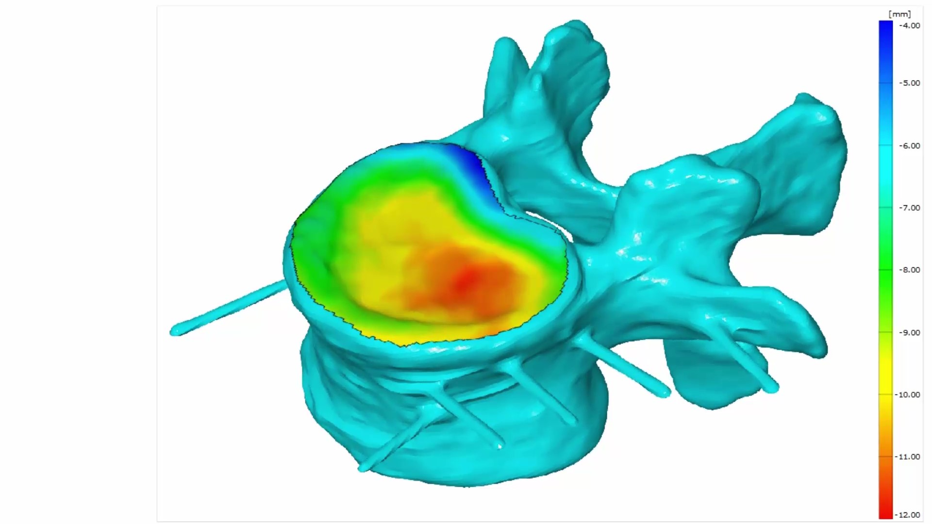 Displacement of a Spine Disc during a compression test